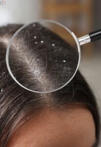 Natural Ways to Remove Dandruff