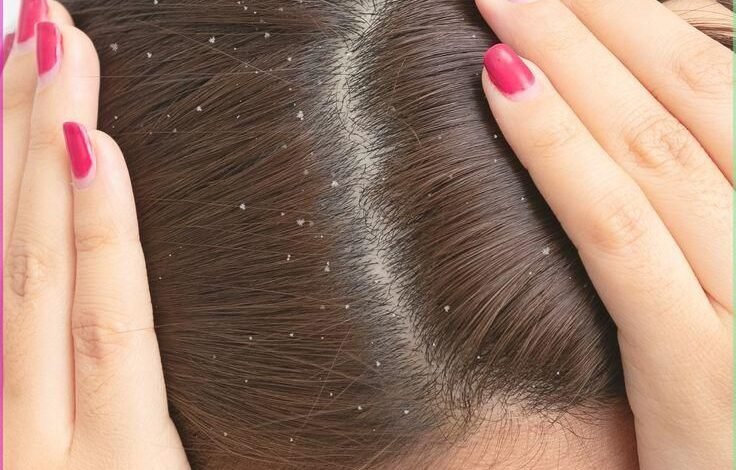 Natural Ways to Remove Dandruff