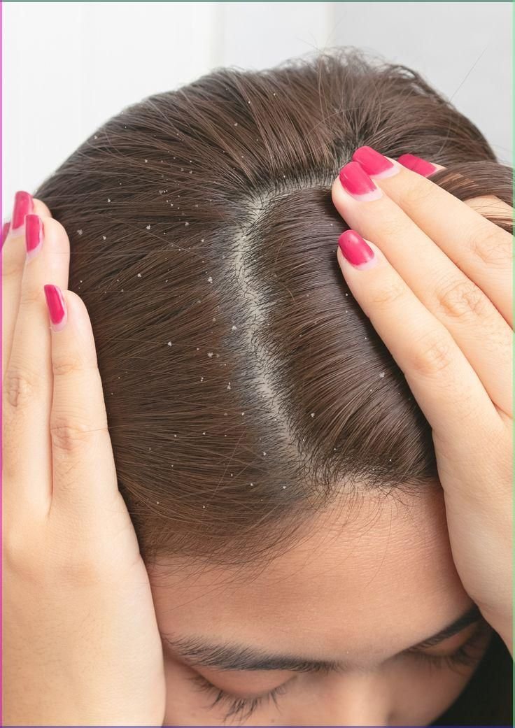 Natural Ways to Remove Dandruff